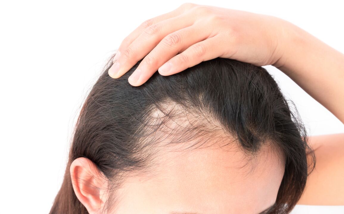 Trichomist Forte baldness and hair restoration spray